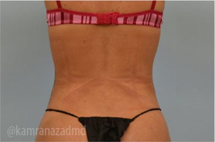 Liposuction Before & After Patient #2903