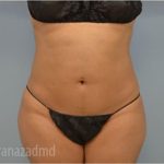 Liposuction Before & After Patient #2904
