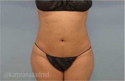 Liposuction Before & After Patient #2904