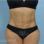 Liposuction Before & After Patient #2904