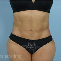 Liposuction Before & After Patient #2904