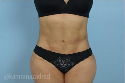 Liposuction Before & After Patient #2904