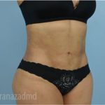 Liposuction Before & After Patient #2904