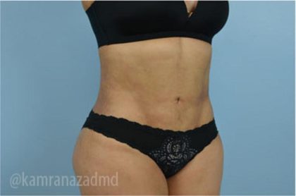 Liposuction Before & After Patient #2904