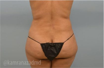 Liposuction Before & After Patient #2904