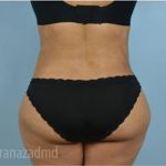 Liposuction Before & After Patient #2904