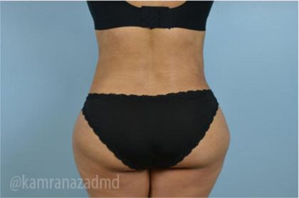 Liposuction Before & After Patient #2904