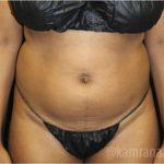 Liposuction Before & After Patient #2905