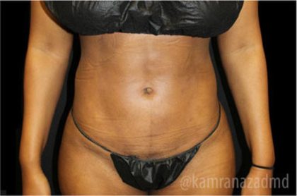 Liposuction Before & After Patient #2905