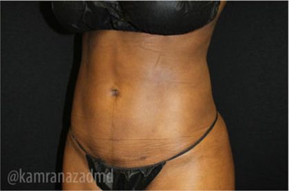 Liposuction Before & After Patient #2905