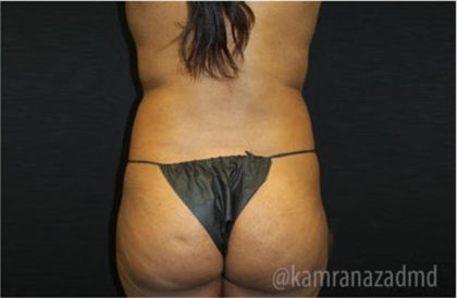 Liposuction Before & After Patient #2905