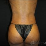 Liposuction Before & After Patient #2905