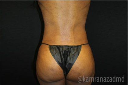 Liposuction Before & After Patient #2905