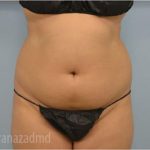 Liposuction Before & After Patient #2906