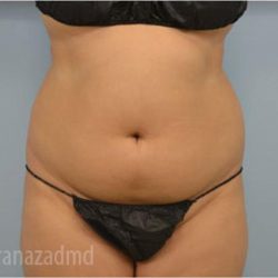 Liposuction Before & After Patient #2906