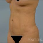 Liposuction Before & After Patient #2906