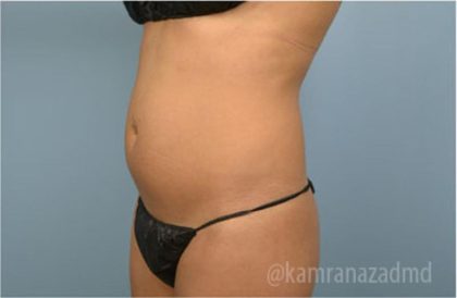 Liposuction Before & After Patient #2907