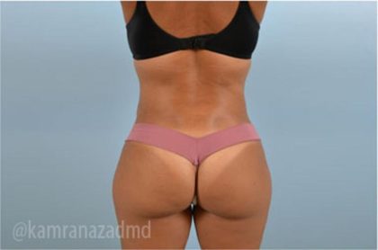 Liposuction Before & After Patient #2907