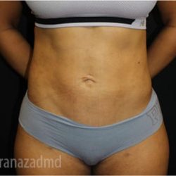 Liposuction Before & After Patient #2908