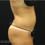 Liposuction Before & After Patient #2908