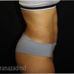 Liposuction Before & After Patient #2908