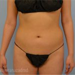 Liposuction Before & After Patient #2874