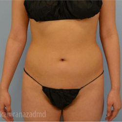 Liposuction Before & After Patient #2874