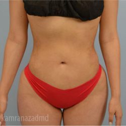 Liposuction Before & After Patient #2874