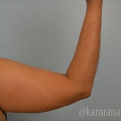Liposuction Before & After Patient #2875