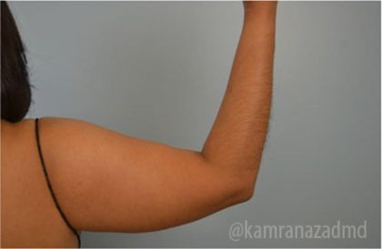 Liposuction Before & After Patient #2875