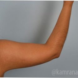 Liposuction Before & After Patient #2875