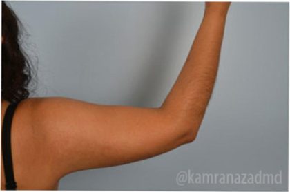 Liposuction Before & After Patient #2875
