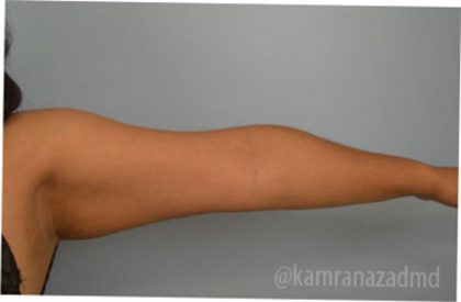 Liposuction Before & After Patient #2875