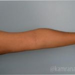 Liposuction Before & After Patient #2875