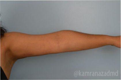 Liposuction Before & After Patient #2875
