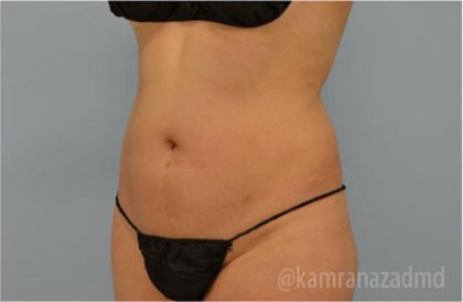 Liposuction Before & After Patient #2876