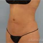 Liposuction Before & After Patient #2876