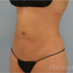 Liposuction Before & After Patient #2876