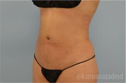 Liposuction Before & After Patient #2876