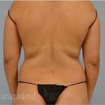 Liposuction Before & After Patient #2876
