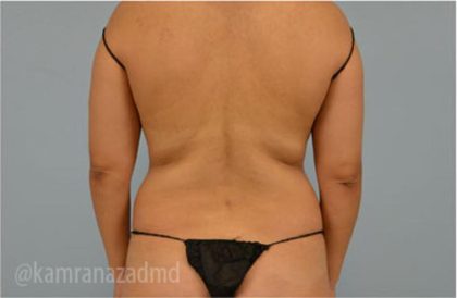 Liposuction Before & After Patient #2876