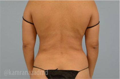 Liposuction Before & After Patient #2876