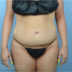 Liposuction Before & After Patient #2877