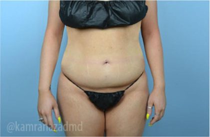 Liposuction Before & After Patient #2877