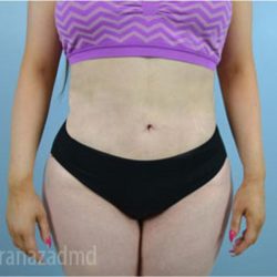 Liposuction Before & After Patient #2877