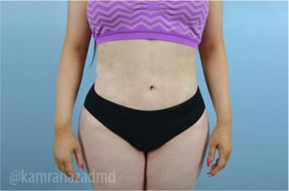 Liposuction Before & After Patient #2877