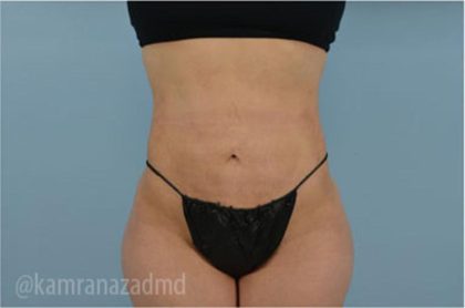 Liposuction Before & After Patient #2878