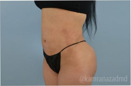 Liposuction Before & After Patient #2878