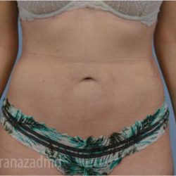 Liposuction Before & After Patient #2879