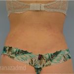 Liposuction Before & After Patient #2879
